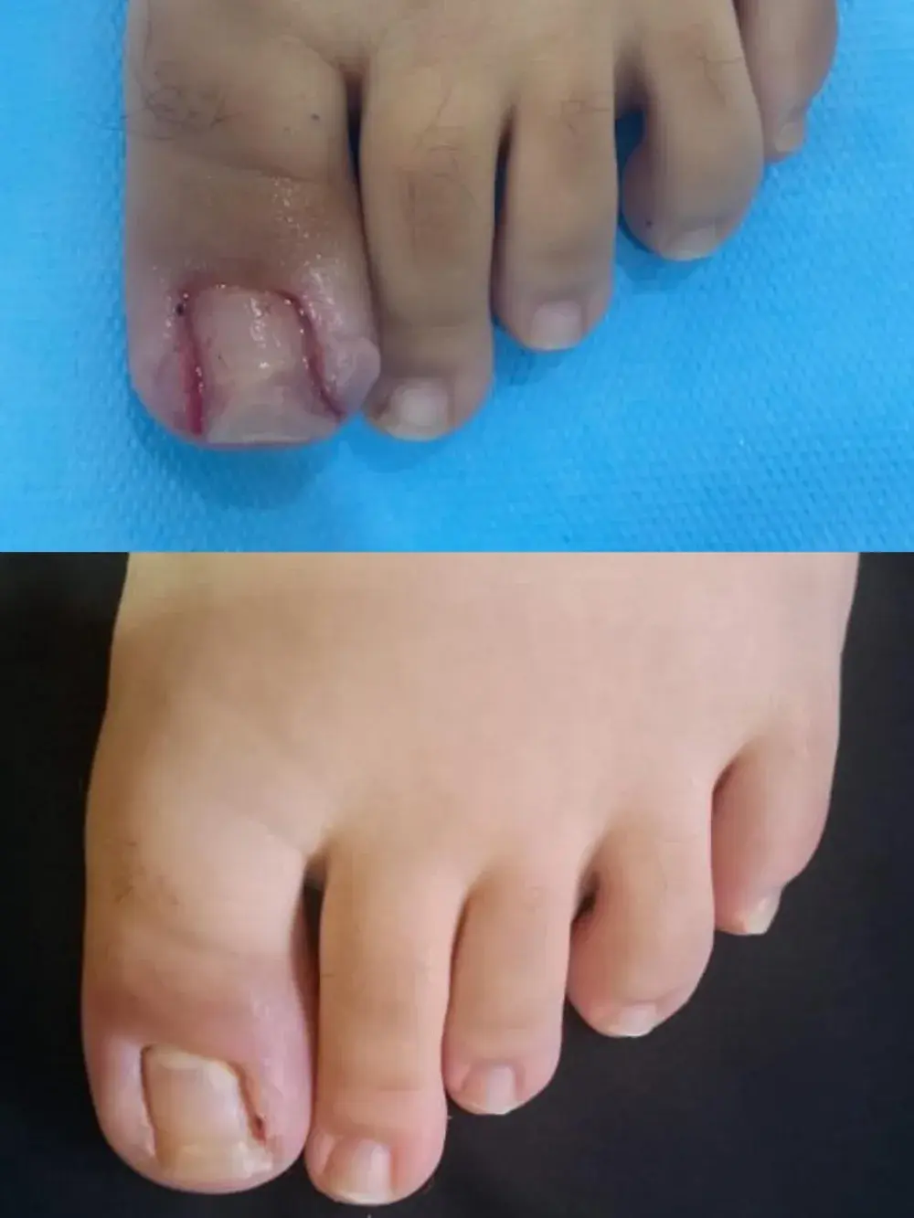 Photographies avant (en haut) et après (en bas) d'une chirurgie de l'ongle du gros orteil